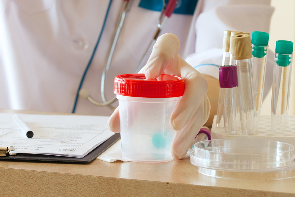 Cloudy Urine – Causes and Home Remedies