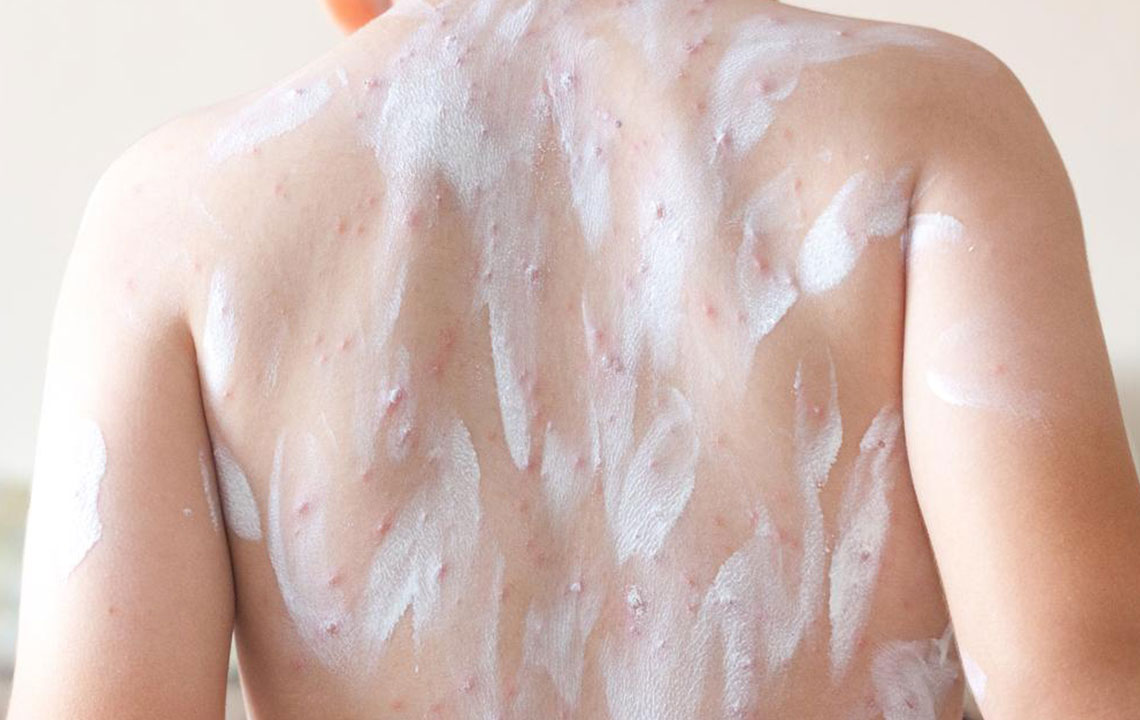 Atopic Dermatitis – Treatment Options That Can Be Tried at Home